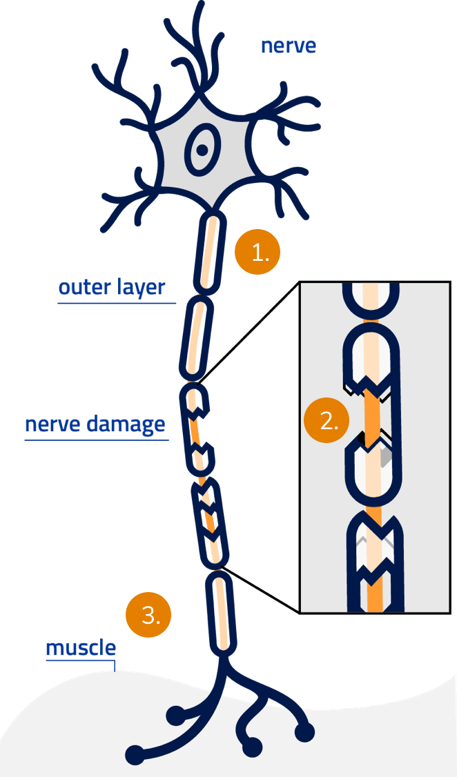 Image of damaged nerve.