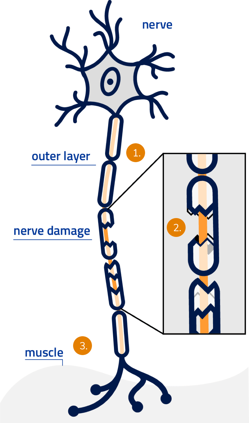 Image of damaged nerve.