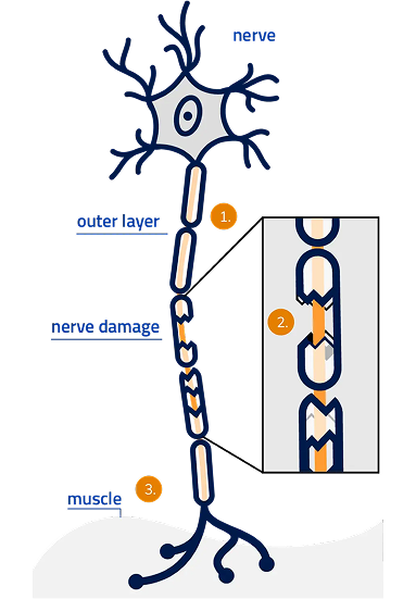 MMN nerve damage graphic.